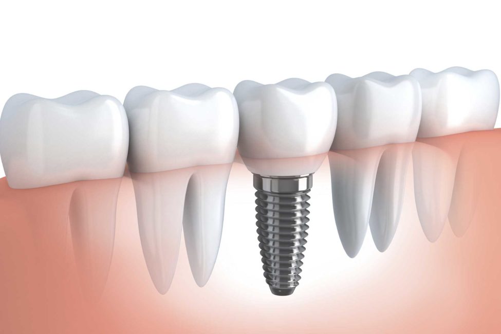 impianto dentale impianto dentale